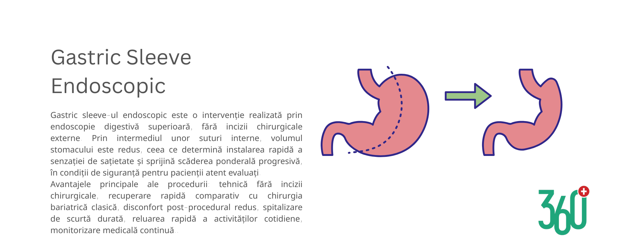 Gastric Sleeve